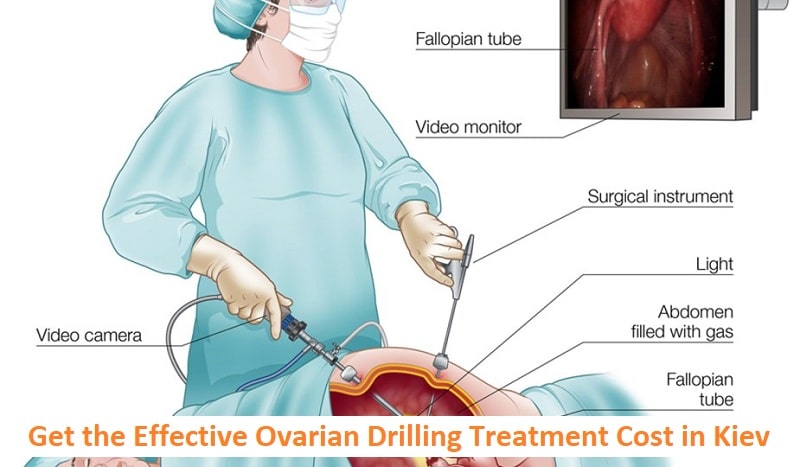 Ovarian Drilling Treatment Cost in Kiev